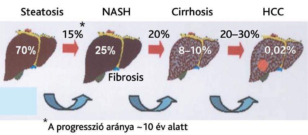 Az új direkt ható antivirális szereknek köszönhetően a hepatitis C-vírus-fertőzés eliminációjának a lehetősége a figyelmet a leggyakoribb krónikus májbetegség, a nem alkoholos zsírmáj (non-alcoholic