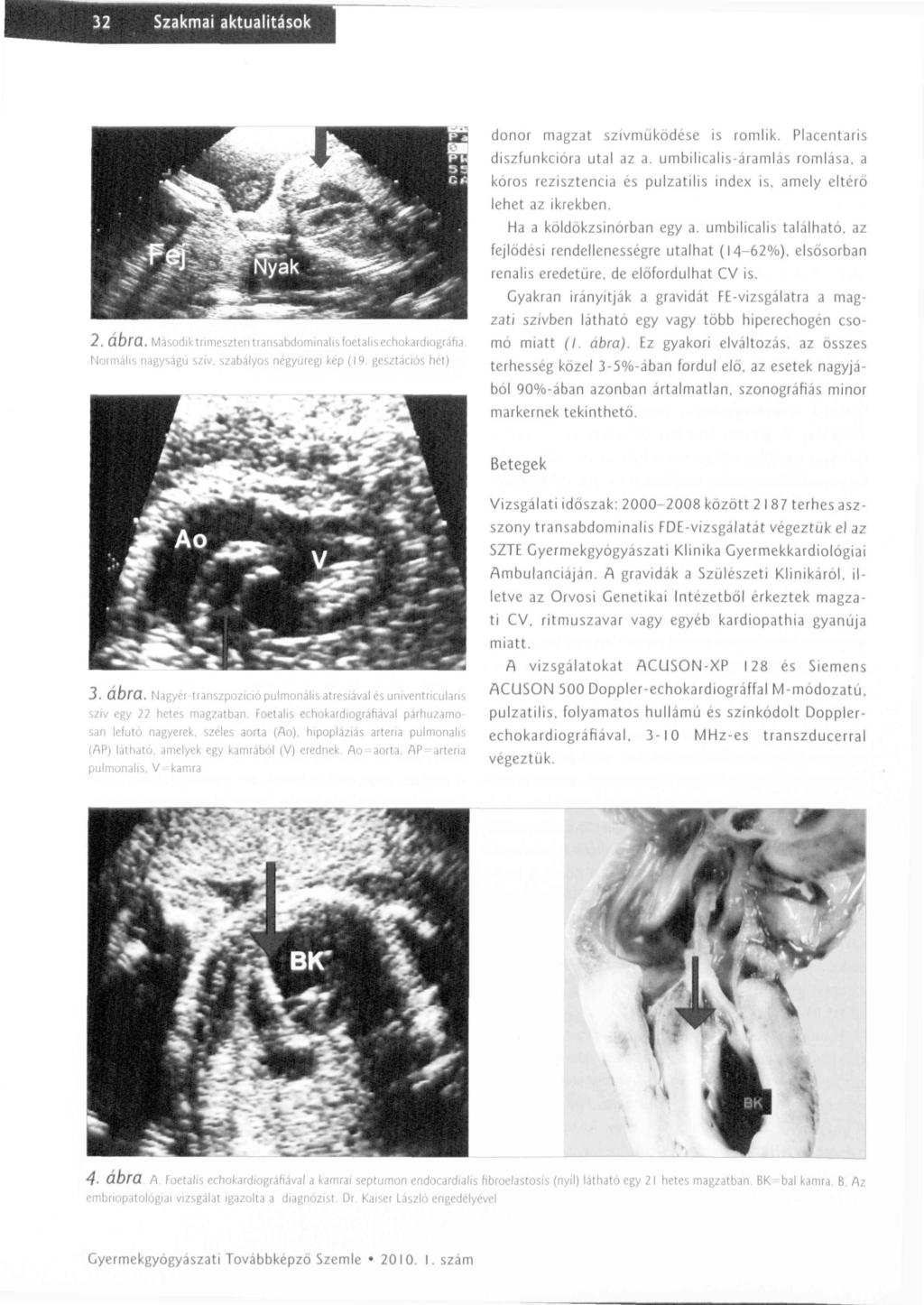 Szakmai aktualitások 2. ábra. Második trimeszten transabdominalis foetalis echokardiograha. Normális nagyságú sziv. szabályos négyüregi kép (19. gesztációs hét) donor magzat szívműködése is romlik.