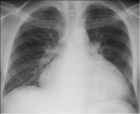 immunserológia mellkas rtg echocardiographia kardiális MR