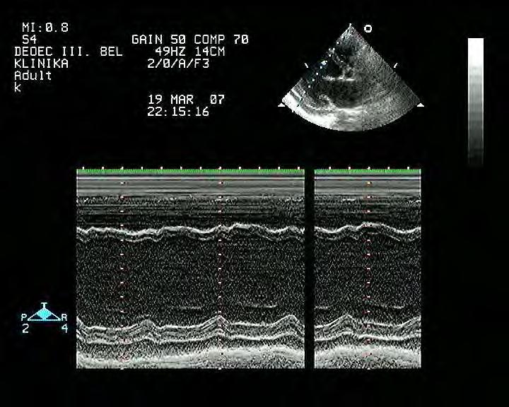 ECHOCARDIOGRAPHIA tág BK,