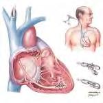 ENDOMYOCARDIALIS BIOPSZIA 1.Postmyocarditises állapot az EMB nem mutat eltérést, korábbi vírusinfectio bizonyított, de a myocardiumban víruspersistálás nem mutatható ki (klinikailag DCM) 2.