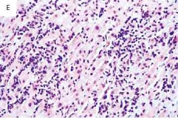 AKTÍV MYOCARDITIS DALLAS KRITÉRIUMOK lymphocyta