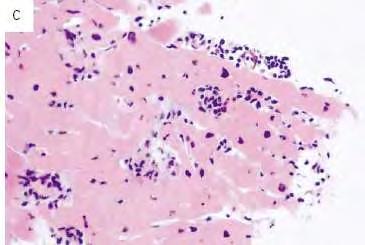 BORDERLINE MYOCARDITIS szövetnecrosis nélküli lymphocyta