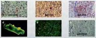 ENDOMYOCARDIALIS BIOPSZIA