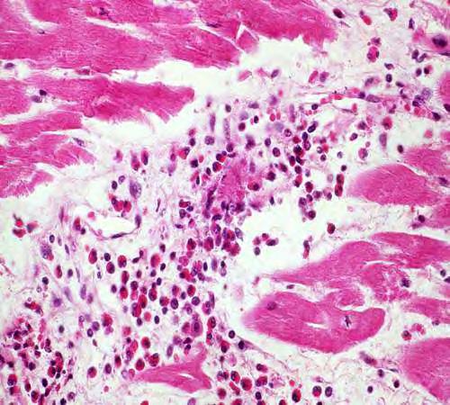 EOSINOPHYL INFILTRACIO A MYOCARDIUMBAN
