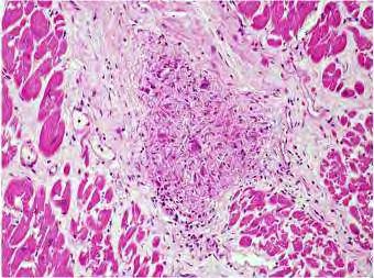MYOCARDIUMBAN