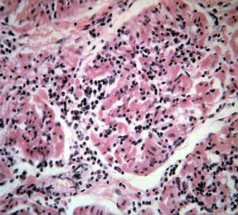 LYMPHOCYTAS INFILTRACIO A MYOCARDIUMBAN