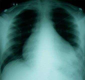 PERICARDITIS