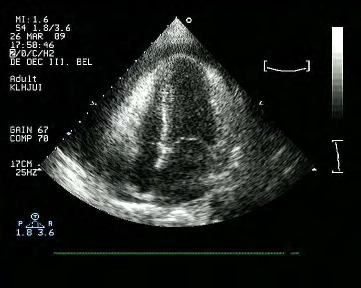 exsudativ serosus