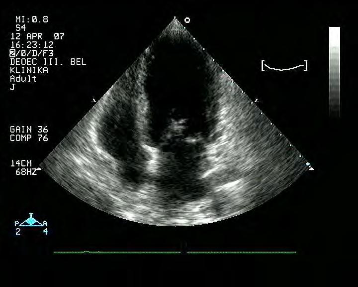 ENDOCARDITIS/VAVULOPATHIA Valvulopathia Thromboticus