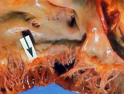 ENDOCARDITIS