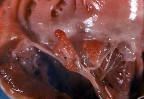 endocarditis Non