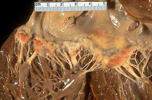 endocarditis