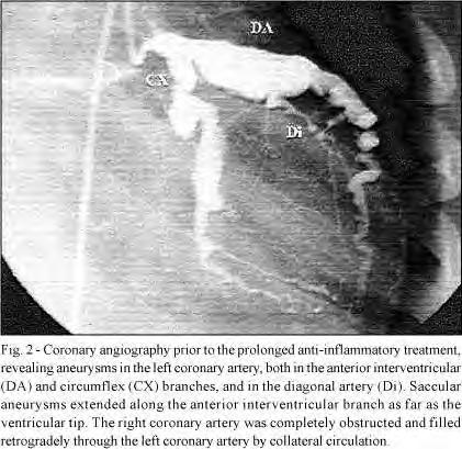CORONARITIS VASCULITIS