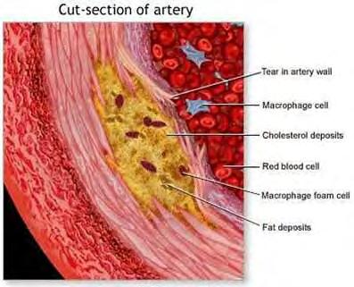 ACCELERÁLT ATHEROSCLEROSIS KLINIKAI