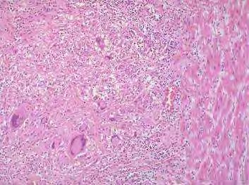 CONSTRICTIV PERICARDITIS ETIOLÓGIA krónikus fibrotizáló gyulladás