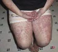 receptorok számában 1 Visszatérő bakteriális infekciók Abdominal összenövések AA amyloidosis (ritka) Testhőmérséklet ( C) 40 39 38 37 36 0 2 4 6 Idő (napok) Lázgörbe HIDS/MKD-ben Simon A, et al.