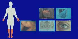 Clinical manifestation of diabetic neuropathy Peripheral