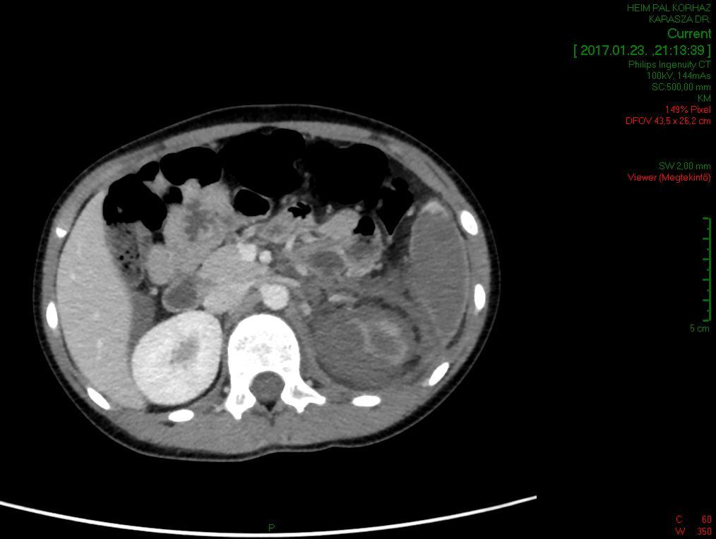 15. Hsu W, Mitchell SE, Kim HS. Renal artery stenting for intimal flap injury in a 2- year-old child after blunt abdominal trauma. South Med J 2006; 99:884-7. 16.