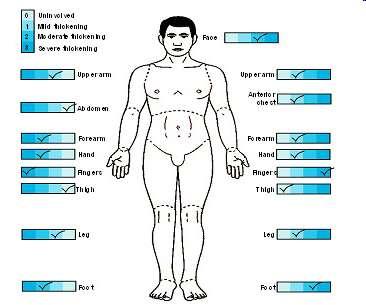 A Rodnan féle bőrpontszám 17 régió bőre Súlyosság 0-3 Max.