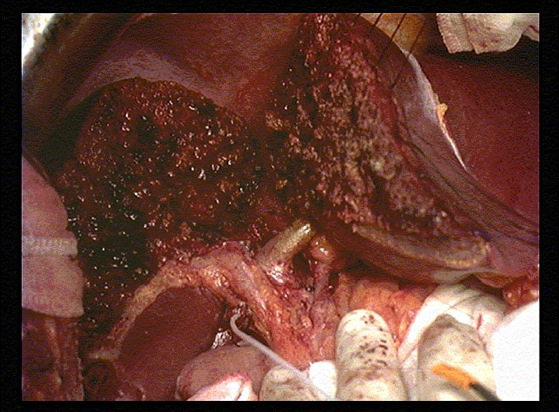 SZÖVŐDMÉNYEK SZEGMENT ESETÉN: Epe-leak, érszövődmények (4-6 %) ÉLŐDONOR: epe-leak, vérzés, mélyvénás thrombosis, tüdőembólia, májelégtelenség (sporadikus) 4%?