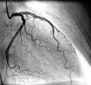 (Myocardialis SPECT - amennyiben ennek eredménye a szívizomban jelentős