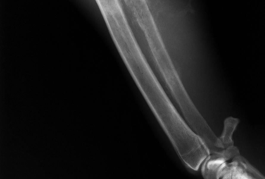 chondro-, fibrosarcoma) Fokozatosan kialakuló, egyre súlyosabb progresszív folyamat sántaság Fiz. vizsg.