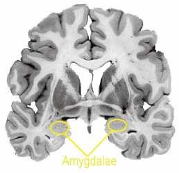 Amygdala A negatív affektusok percepciója és produkciója Bilaterális lézió: a félelem arckifejezésének felismerési