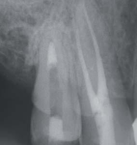 A pácienst a korábban mély caries miatt gyökérkezelt 17-es fog rágásra és kopogtatásra jelentkező érzékenysége
