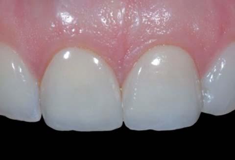 Ám vizsgálatunkkor ezek a fogak nem voltak mozgathatóak és ép periodontalis viszonyokat találtunk.