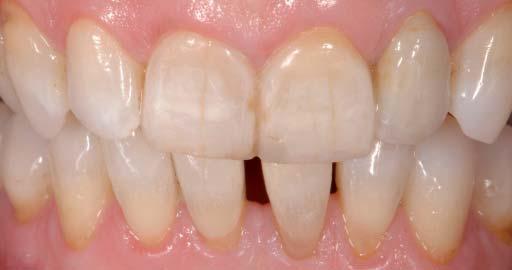 Fogászati anamnézis A frontfogak vizsgálata során fluorosis okozta