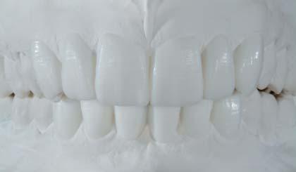 Diagnosztikus kompozitmintázat A mesterminta elemzése az első ülésben (nulladik alkalom) A diagnosztikus fázis alatt nagyobb figyelmet fordítottunk a gingiva aszimmetriájára az 1 és 2-es