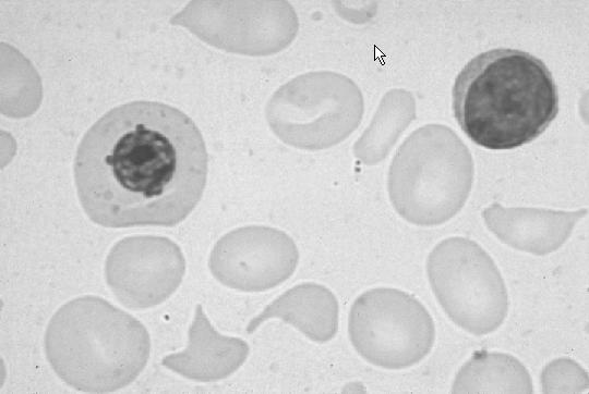 Anaemia perniciosa Normális Makrocitózis Anisocytosis nagyságbeli eltérések Poikilocytosis alaki eltérések A vörösvértest
