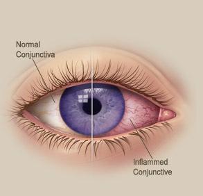 Conjunctivitis (kötőhártya gyulladás) Jellegzetes tünete: piros szem Conjunctiva > subconjunctivalis ktsz > sclera (normálisan fehér)