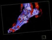MTP ízületi punkció mellett CT (HRCT és DECT), MRI és ultrahang Diagnosztikai kritériumok (relatív kritériumok)
