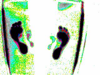 Bemutatom 3 gyermek talpnyomatának változását 1.vizsgálat 2.vizsgálat 1.vizsgálat során: harántboltozati ív bal lábon kevésbé fejlődik, mint jobb lábon. Bal lábon erőteljesebb a boka bedőlése.