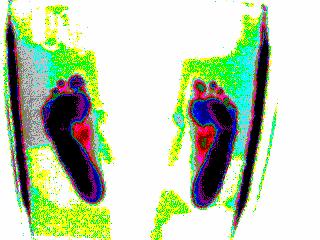 1. vizsgálat 2.vizsgálat 1.vizsgálat során: bal láb dominancia látható. Jobb láb supinatios tartása, ujjak szétállása figyelhető meg. Gyengén alakul a bal lábon a haránt és hosszboltozat ív. 2. vizsgálat: bal és jobb lábon a haránt és hosszboltozat ívek szebben alakulnak.