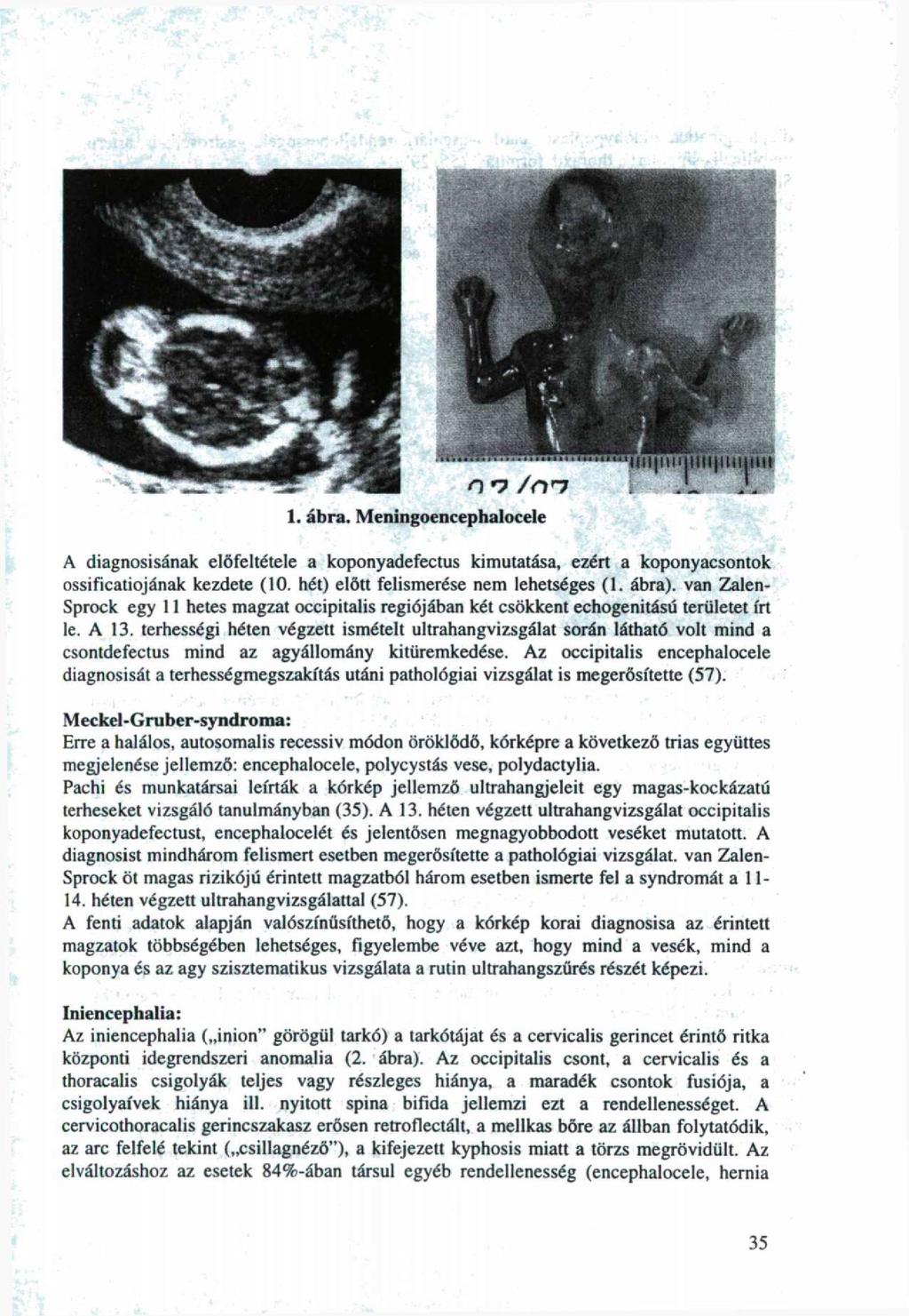 , ábra. Meningencephalcele A diagnsisának előfeltétele a kpnyadefectus kimutatása, ezért a kpnyacsntk ssificatijának kezdete (0. hét) előtt felismerése nem lehetséges (.