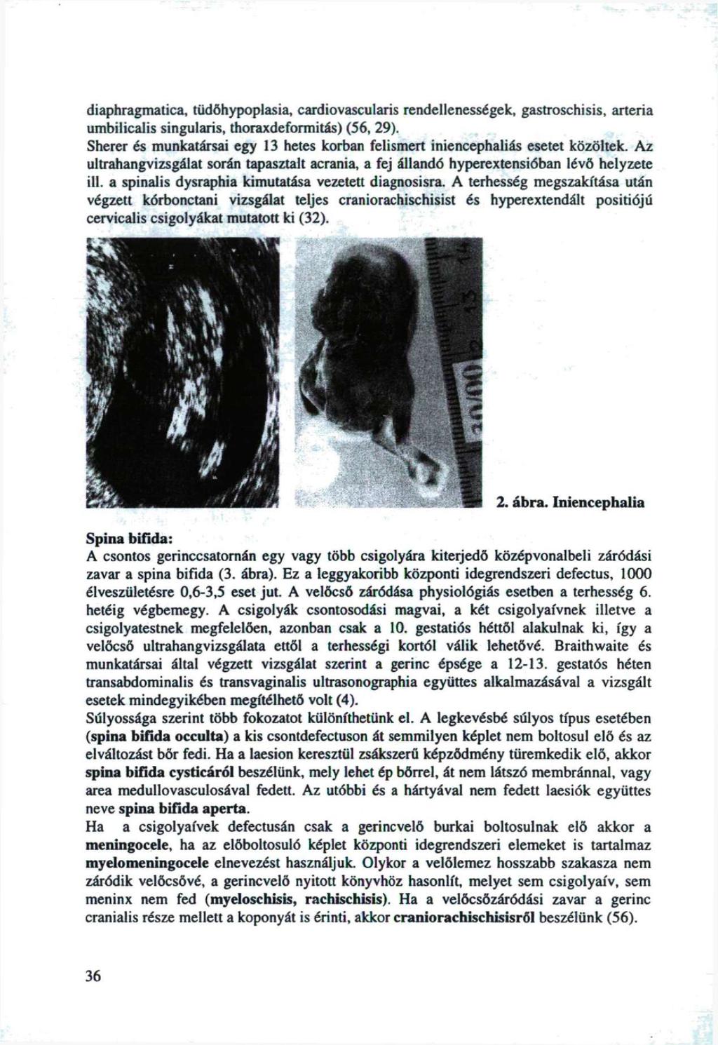diaphragmatica, tüdőhypplasia, cardivascularis rendellenességek, gastrschisis, artéria umbilicalis singularis, thraxdefrmitás) (56, 9).