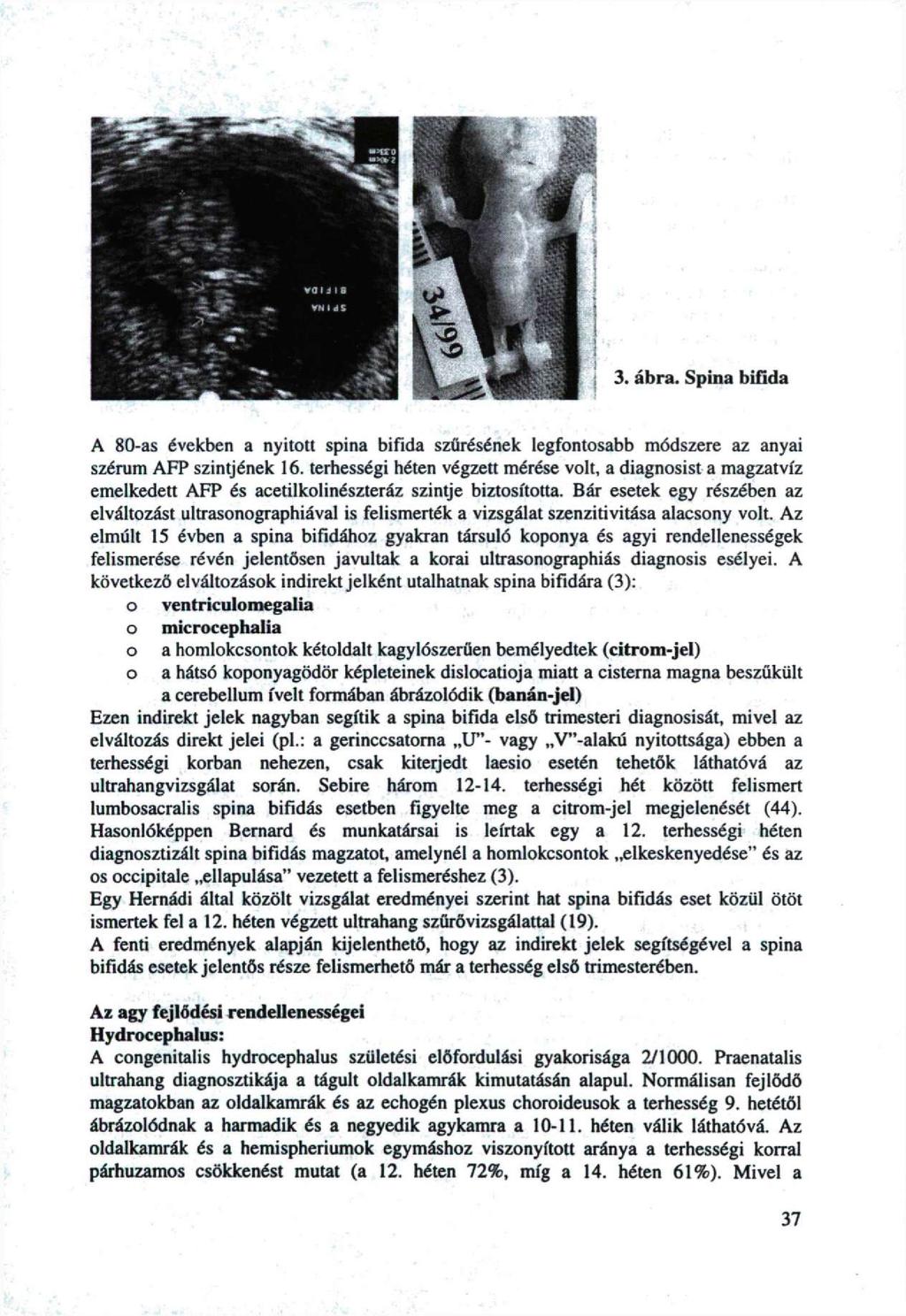 A 80-as években a nyittt spina bifida szűrésének legfntsabb módszere az anyai szérum AFP szintjének 6.