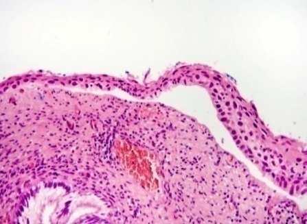 HSIL típusok Típus Laesio HPV típus p16 Exophyticus (condylomatosus)- kiérő Condylomatosus HSIL HR Diffúz Basaloid Metaplasticus HSIL HR Diffúz Flat < 10 sejtsor HR Diffúz Elszarusodó (keratinizáló)