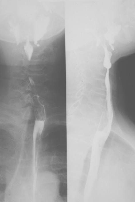 fistula 17 nap alatt spontán záródott. A beteg a tumorrecidíva okozta mediastinitis miatt 3 hónap múlva exitált. Nyelési próba a tágítás előtt és után Ballonkatéter a tágítás elején és végén III.