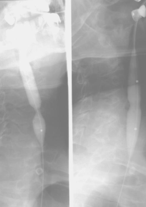 közötti 5 éves időszakban 31 laryngectomián átesett betegünknél a beszédrehabilitáció céljából behelyezett hangprotézissel nyert tapasztalatok elemzését nemzetközileg elfogadott kérdőív segítségével