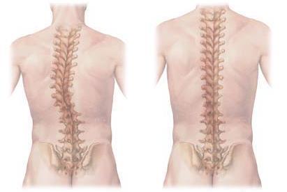 2. ábra: Szkoliotikus gerinc Egészséges gerinc A szkoliózis fajtái: 1. Leggyakoribb (80 %) az ún. idiopáthiás szkoliózis, melynek pontos kiváltó okát nem ismerjük.