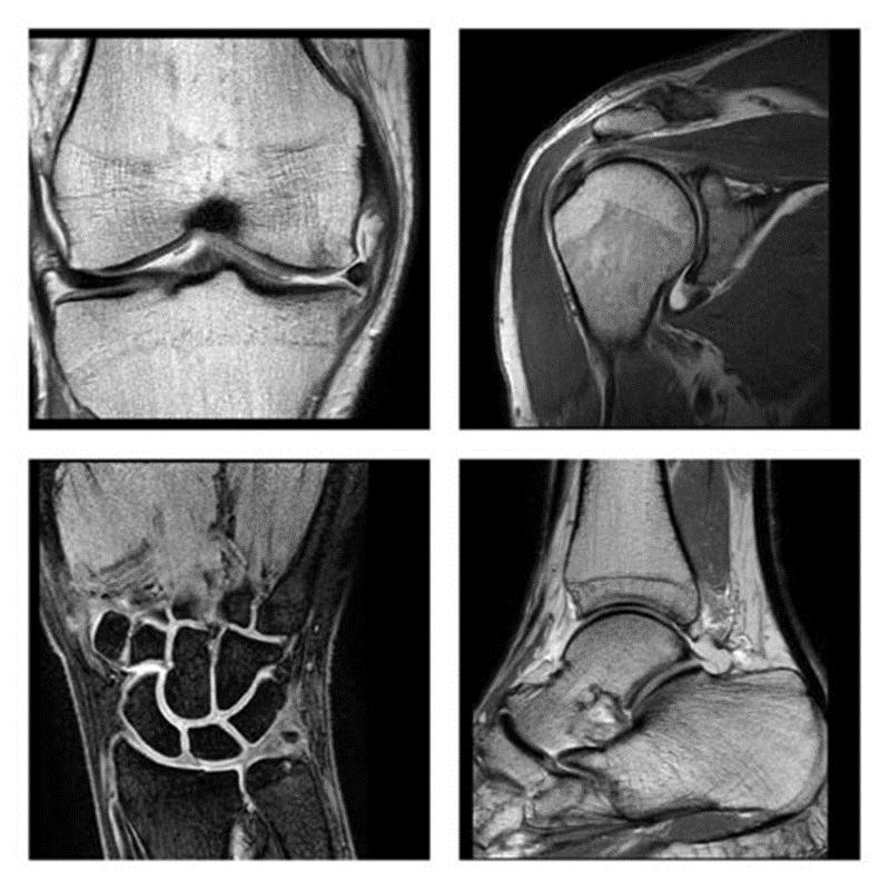 Képalkotó modalitások: MR A legérzékenyebb képalkotó modalitás a lágyrészek ábrázolására Indikációk: csigolya törés, sport sérülések, gyulladás, tumor Fontosabb mérési szekvenciák: Zsírsúlyozású