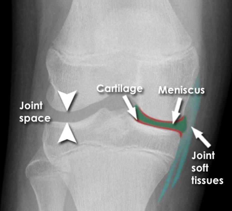 Ízületi rtg anatómia Az ízületi porc, tok, és a szalagok sem jeleníthetők meg Gyermekkorban a radiológiai ízületi rés