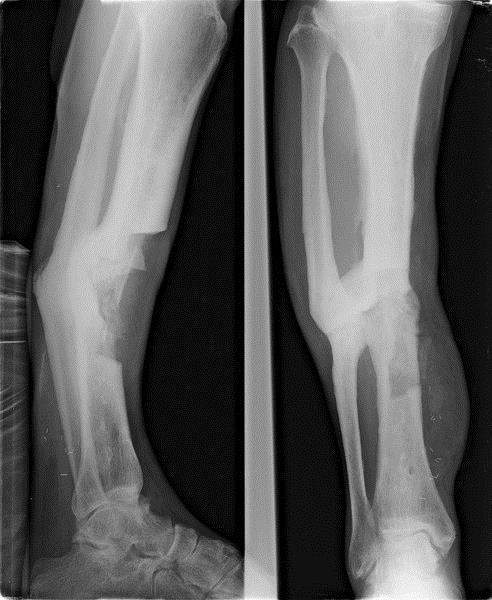 III. Osteosclerosis/hyperostosis Krónikus osteomyelitis,