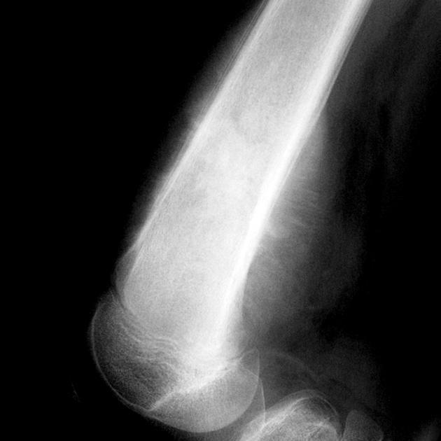 Spiculált Perpendicularis (hair-on-end) Ewing sarcoma Osteosarcoma