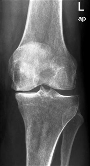 Arthrosis Primer OA elsősorban a testsúlyt támasztó ízületeket érinti (csípő, térd, boka) Másodlagos OA gyulladás, trauma, necrosis, fejlődési rendellenesség következtében Gyulladásos eredetű