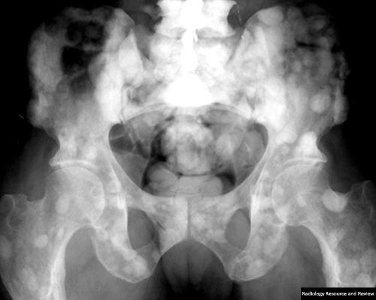 Scleroticus metastasis Primer tumor lehet: Prostata!